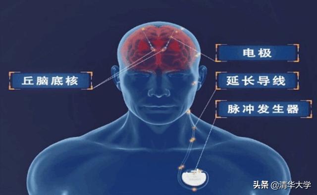国家科学技术进步奖一等奖 拯救大脑的电波：李路明和他的脑起搏器研究团队